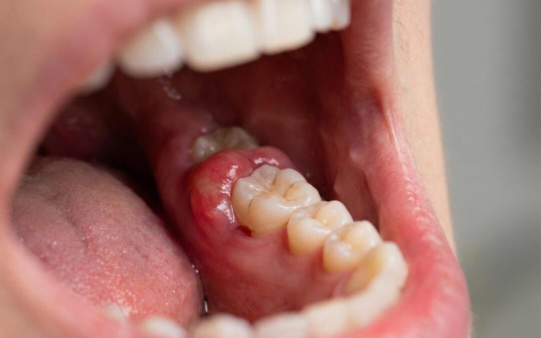 ¿Qué hago cuando me duelen las muelas del juicio?