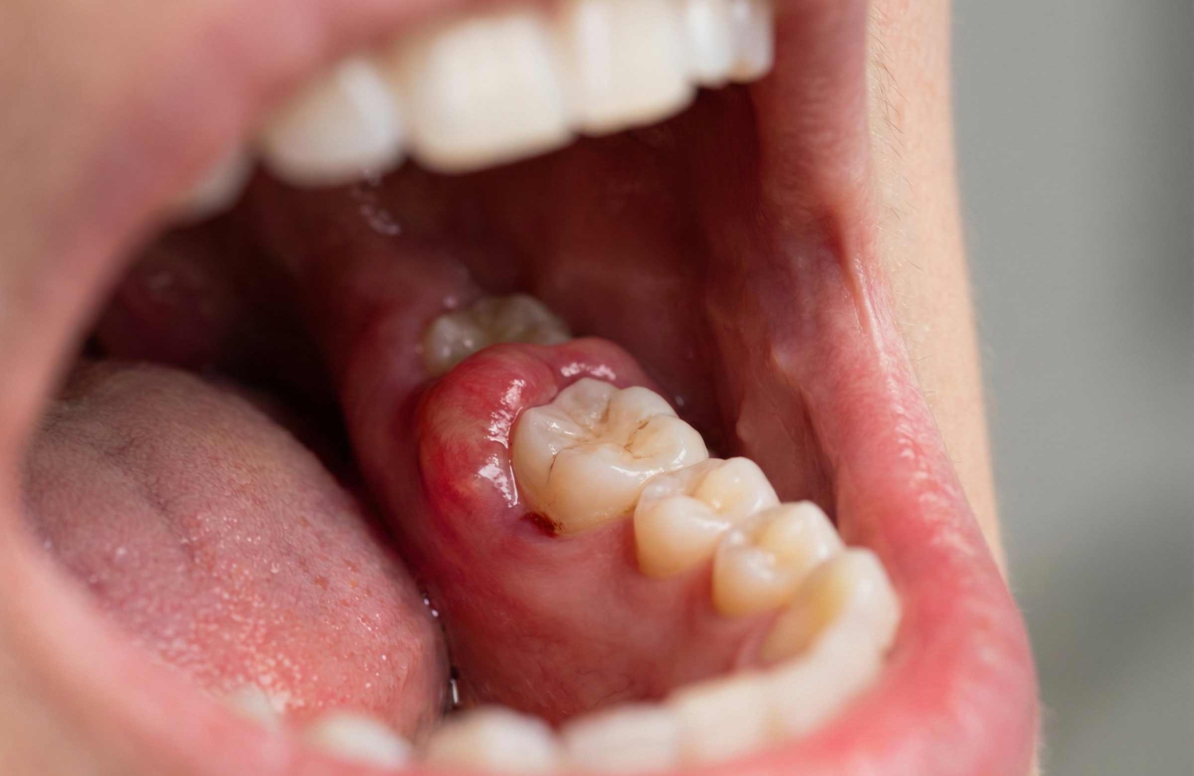 primer plano de muela del juicio parcialmente erupcionada con encía inflamada.