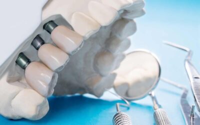 Implantes dentales en Vitoria-Gasteiz: solución fija y segura para recuperar tu sonrisa
