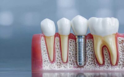 Implantes guiados en Vitoria-Gasteiz: cirugía digital de máxima precisión