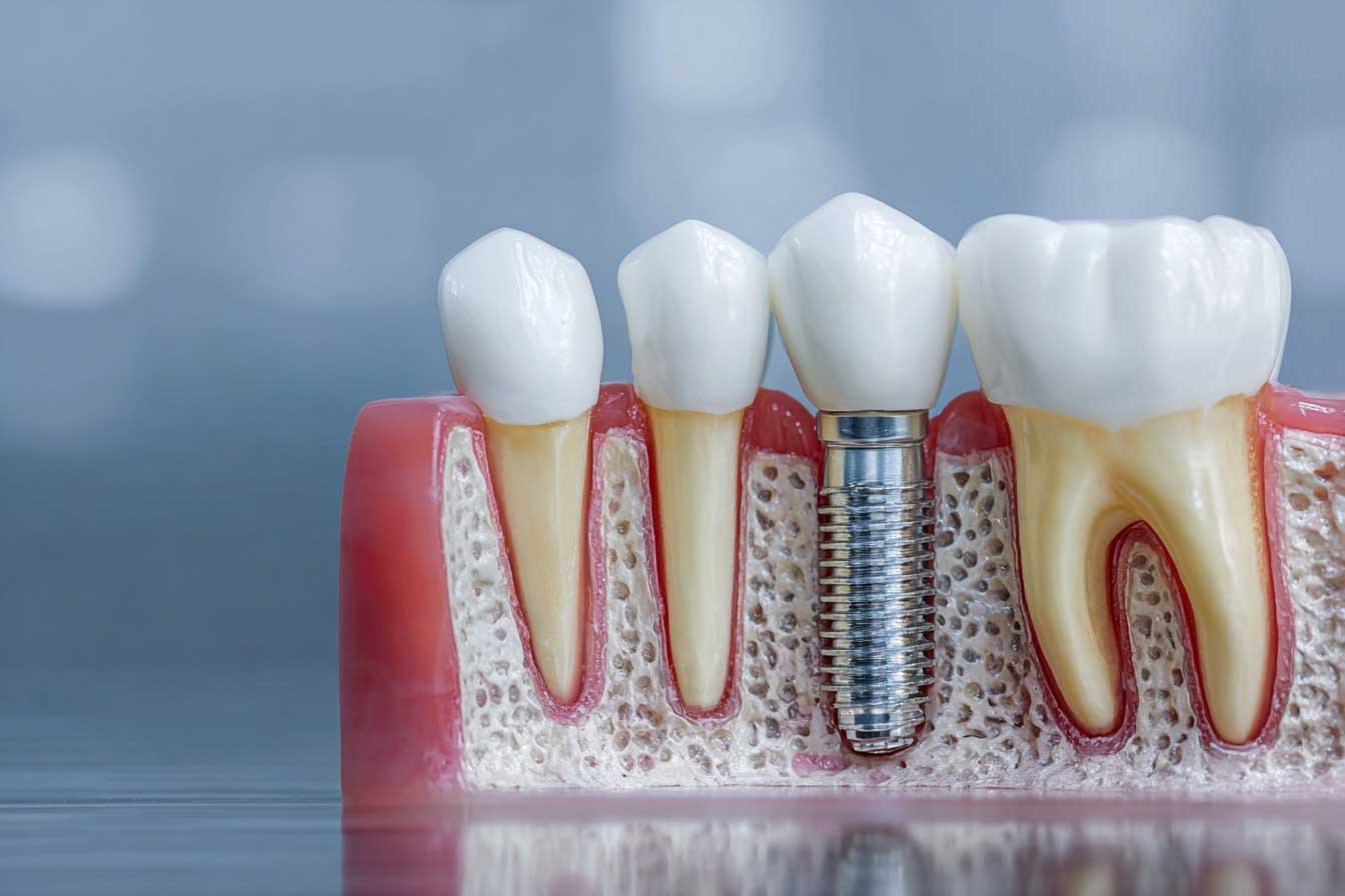 implantes dentales vitoria