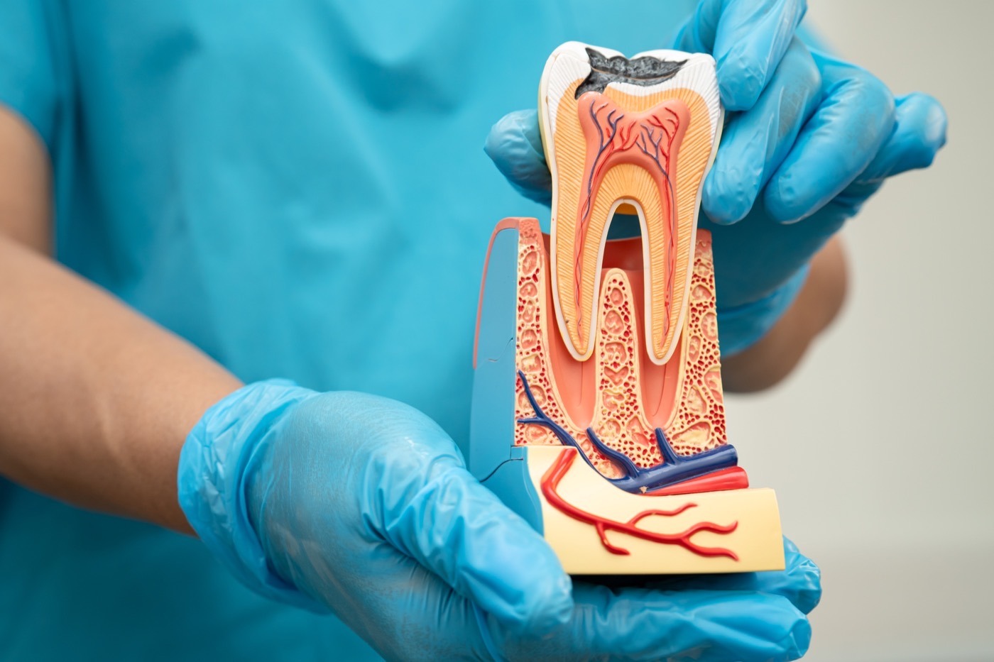 Endodoncia en Vitoria-Gasteiz tratamiento del nervio dental en Clínica Pérez Belmonte