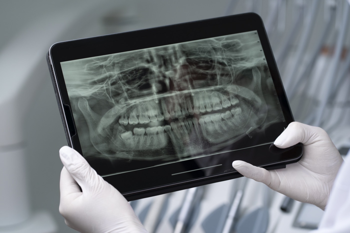 Escáner intraoral 3D en Clínica Dental Pérez Belmonte Vitoria-Gasteiz tecnología avanzada
